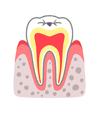 C0：エナメル質が脱灰し始めた、ごく初期の虫歯