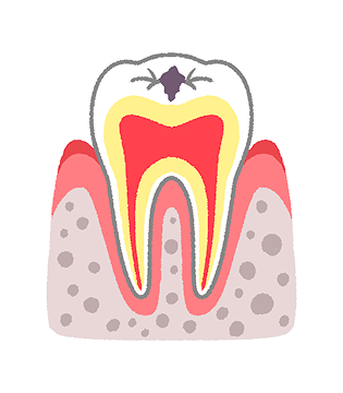 C1：歯の表面（エナメル質）に小さな穴が生じた虫歯
