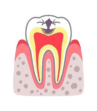 C2：歯の内部の象牙質まで進行した虫歯