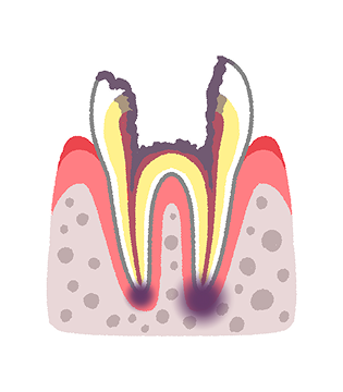C4：歯の根まで進行した虫歯