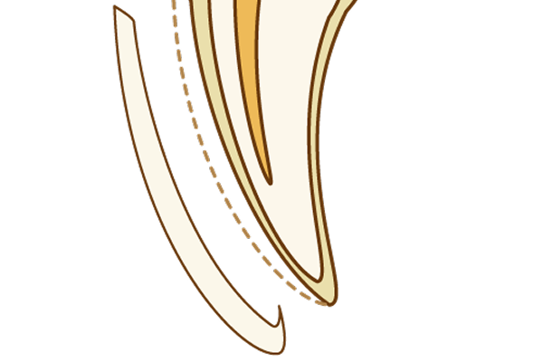 フルラミネートベニア