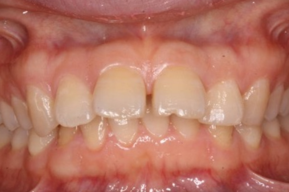 Before